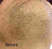 Laser Hair Removal